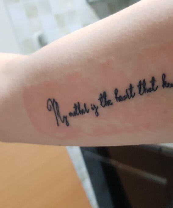 Red skin - allergies